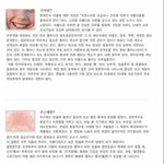 영원한 적~! <b>기미</b>, 주근깨란..?