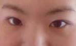 쌍꺼풀 <b>재수술</b>하신분들..조언좀 (사진있음)