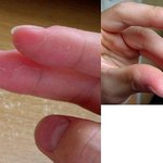 고민이에요;; 이게 <b>습진</b>인가요??