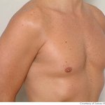 미국 성형계의 트랜드 남자 가슴 성형<b>수술</b>