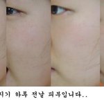 피부가 ..왜 이런건지..<b>지루</b>성 피부염이라는데..
