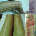 ipl시술후 전신 20% 2도 화상!! 하지만 병원에선 책임없다...