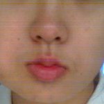 사랑니 <b>발치</b>후 계속적으로 부워요~~