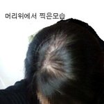 20대<b>초반</b> 여자인데..대머리가 될꺼같아요