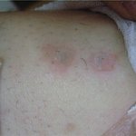 제모 시술 받은후 <b>화상</b> 입었습니다 (사진있음)