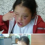 어린이집 <b>원장</b>에게 맞은 아이의 비참한 모습