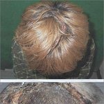 <b>모발</b> 탈색제로 화상을 입은 환자
