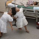 수술할 날만 기다려요.. 인도의 샴 쌍둥이 vani 와 veena