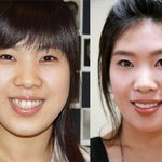 강유미 덧니 빼기 <b>전과</b> 덧니 뺀 후