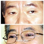노대통령, 눈꺼풀 수술 <b>전후</b>