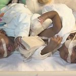 짐바브웨 샴쌍둥이