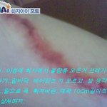 크하하;;<b>영광</b>?의 상처-0-ㅋ