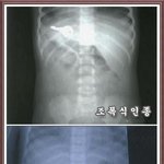 어린아이 <b>몸속</b>에 있던 물체