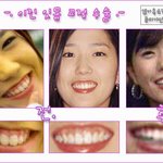 <b>이진</b> 치아잇몸성형 전후사진(효리,,교정전후사진)
