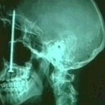 얼굴에 박힌 10㎝ <b>대못</b> 뒤늦게 발견(해외토픽)