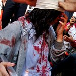 물대포 직격에 여고생 <b>실명</b>위기