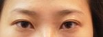 연예인의 급 예뻐지는 방법 노마드 <b>뒤트임</b>성형???