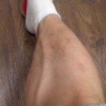 저 하지정맥류 인가요? [사진첨부]