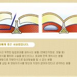 [힙업성<b>형</b>,힙업성형수술,힙업] 섹시한 힙<b>라인</b>, 진정한 s<b>라인</b>의 완성