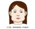 [성형,이마성형,안면윤곽성형] 사각턱 성형