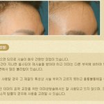 [이<b>마성</b>형 , 이<b>마성</b>형수술] 나의 자신감, 시작은 이마에서부터