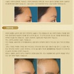 [<b>미즈</b>성형외과] 튀어 나온 눈썹, 이마성형으로 해결한다