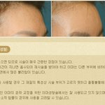 [<b>미즈</b>성형외과] 이마가 동그랗고 예쁘면 이미지가 확 바뀐다