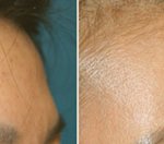 [이마성형 , 이마성형수술] 기품 있는 이미지, 이마의 모양이 <b>좌우</b>한다