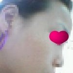 저 진짜 코수술할까요 말까요