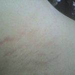 이게 튼<b>살</b>이라는 건가요? 사진有