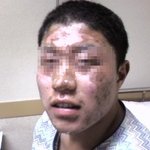 얼굴에폭탄이(사진있음)