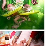 3 개월후에 수술할 <b>샴쌍둥이</b>.. 수영하고 있네~