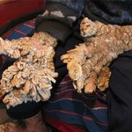 세계 초유 희귀병 '장갑손' 유럽男