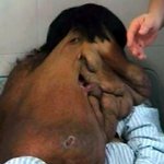얼굴에 <b>종양</b>이 15kg되는 코끼리 남자