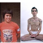 25년간 거식증에 시달린 미국남성..