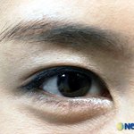 <b>라식</b>수술 하기 전 검사해야할 10가지