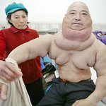 중국남성 목에 15kg <b>종양</b> 덩어리