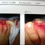 래미안 신발장 문에 발가락 잘린 5살배기