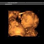 엄마 <b>뱃속</b>에서 키스하는 쌍둥이 초음파 사진!! 진짜 선명하다!!