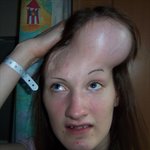 머리에 풍선넣어 목숨 건진 영국 소녀