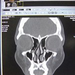 이민영, 코 <b>ct</b> 촬영 필름 공개