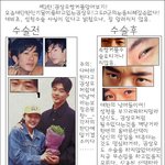 [속보]권상우 상커플 수술 <b>전후</b>!!