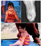 인어다리증으로 150회 이상의 다리<b>분리</b> 수술을 받은 8살의 소녀!