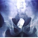 <b>항문</b>크기가 남달랐던 아저씨...