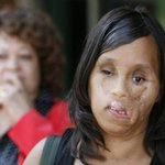 남친 폭력으로 얼굴의 80% 잃어버린 미국 여성