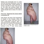 <b>뱃살</b>만 57키로인 여성!!어쩌냐...