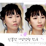 충격 신봉선 얼굴<b>전체</b>성형!