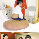 엉덩이에 45kg 혹을 달고 있던 <b>여인</b>