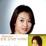 정지영 <b>성형전</b>