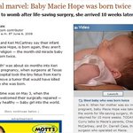 <b>뱃속</b>에서 꺼냈다가 집어넣어서 다시 태어난 아기